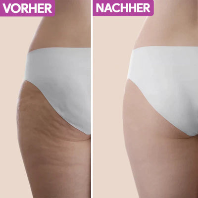 5in1 Anti-Cellulite Massagegerät